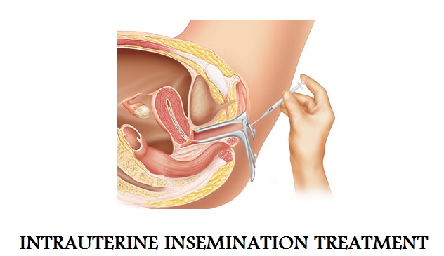 INTRAUTERINE INSEMINATION TREATMENT
